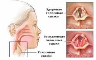 Аллергия в горле – симптомы, причины, диагностика и лечение