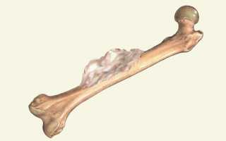 Симптомы рака костей и суставов у взрослых