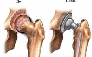 Эндопротезирование тазобедренного сустава: что нужно знать об операции