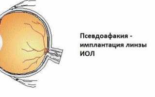 Вам поставили диагноз афакия: что это такое, признаки и методы лечения