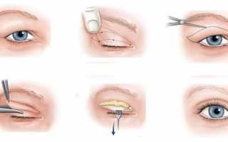 Лечение глазных болезней: удаление халязиона