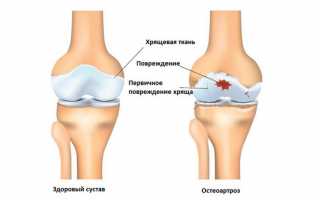 Отложение солей в суставах: как с этим бороться