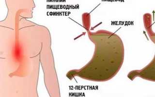 Симптомы и лечение рефлюкс-гастрита