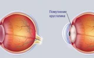 Как сохранить зрение: почему развивается начальная катаракта и как ее предотвратить